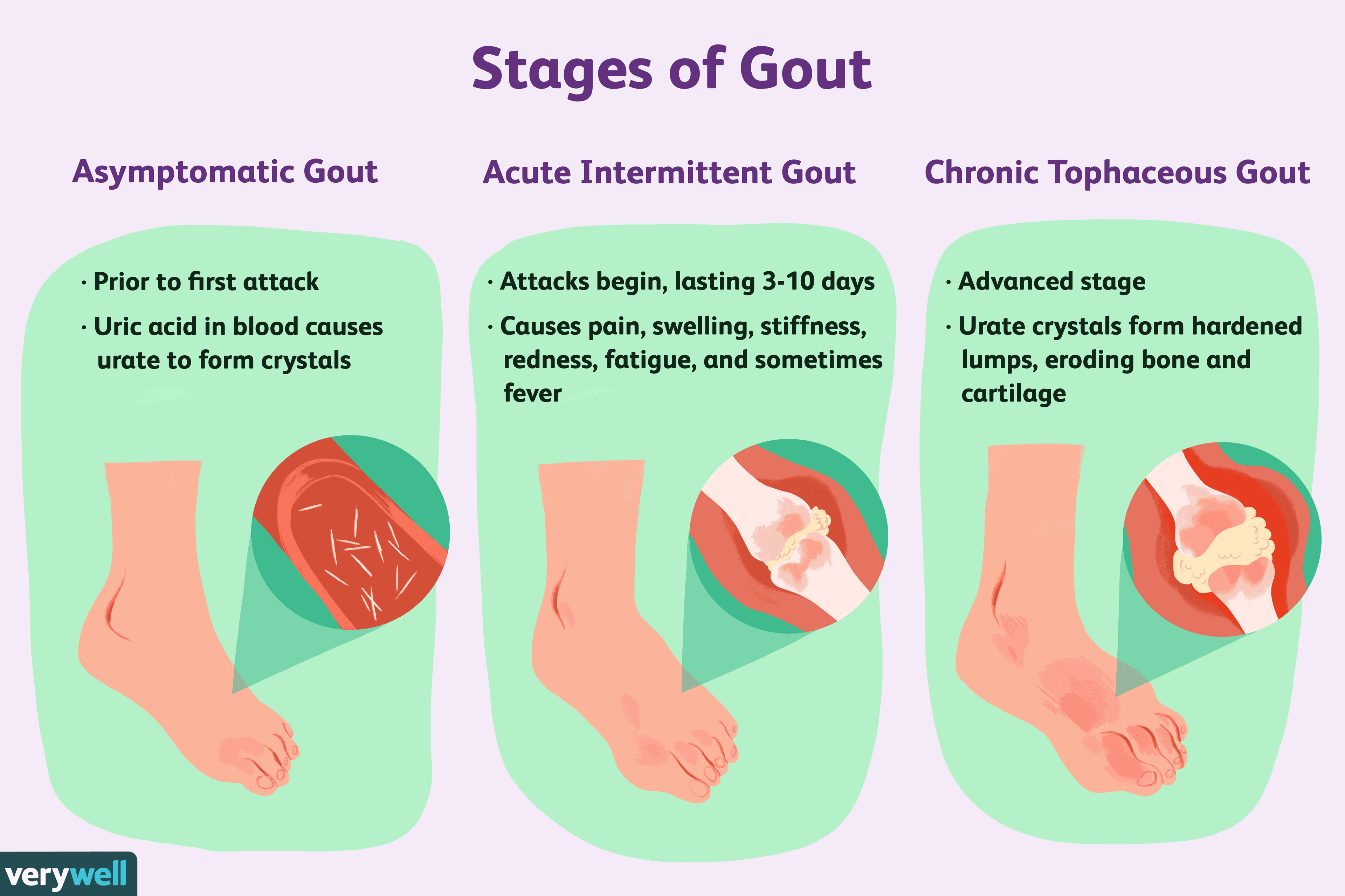 stages-of-gout