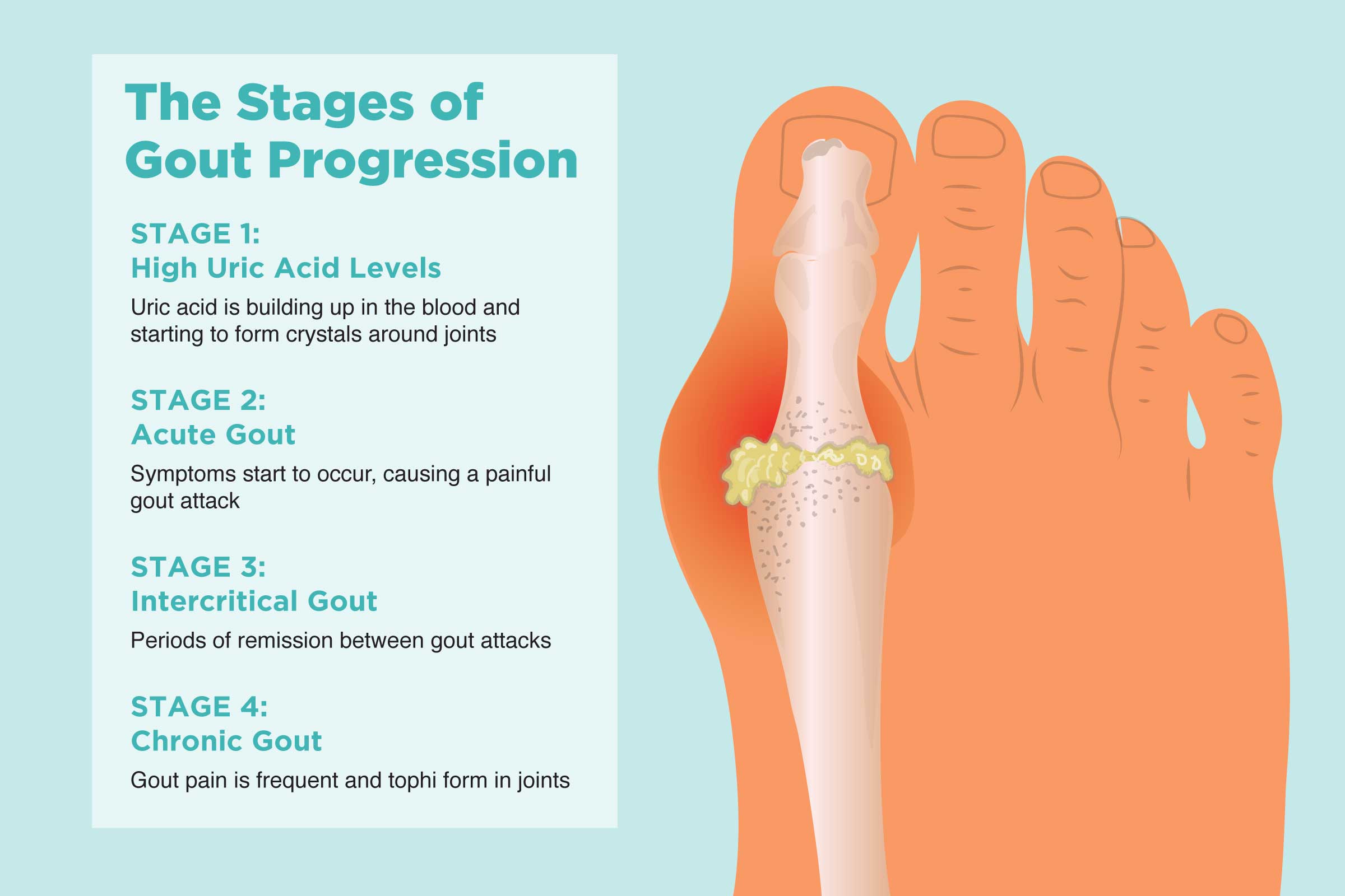 0919 Stages Gout